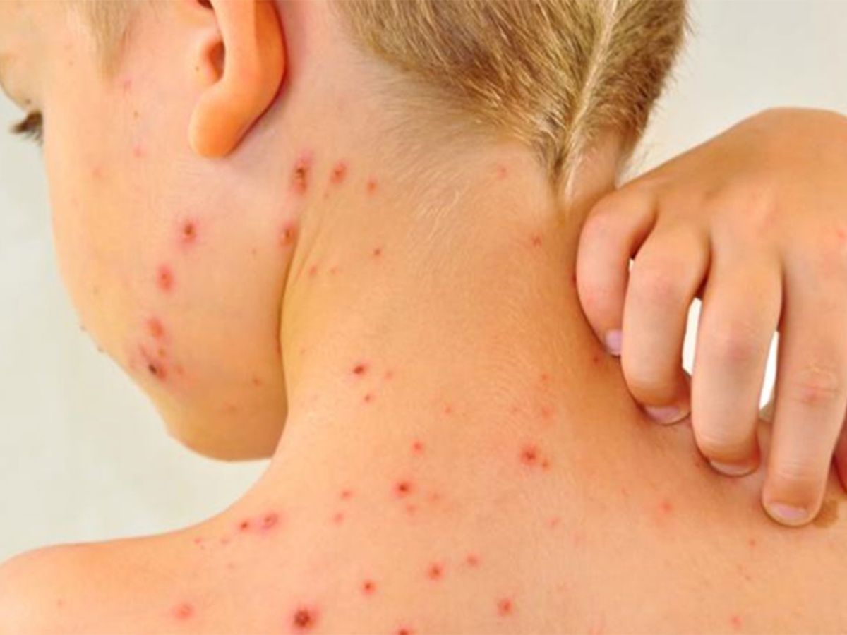 Chiapas declara contingencia epidemiológica por sarampión y recomienda suspender eventos masivos