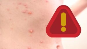 Confirman 5 casos de sarampión en Quintana Roo, dos de ellos en Cancún