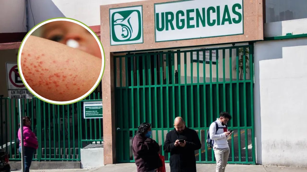 Deceso de menor por sarampión en CDMX