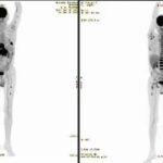 Tratamiento celular brasileño logra la remisión de un cáncer avanzado en apenas un mes