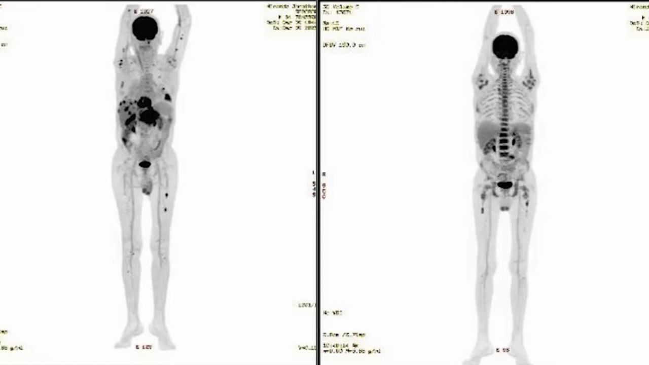 remisión de un cáncer avanzado