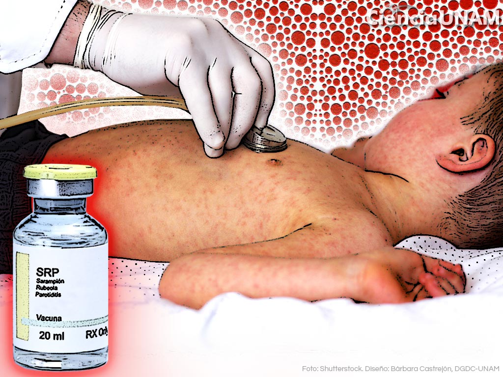 Sarampión en infantes