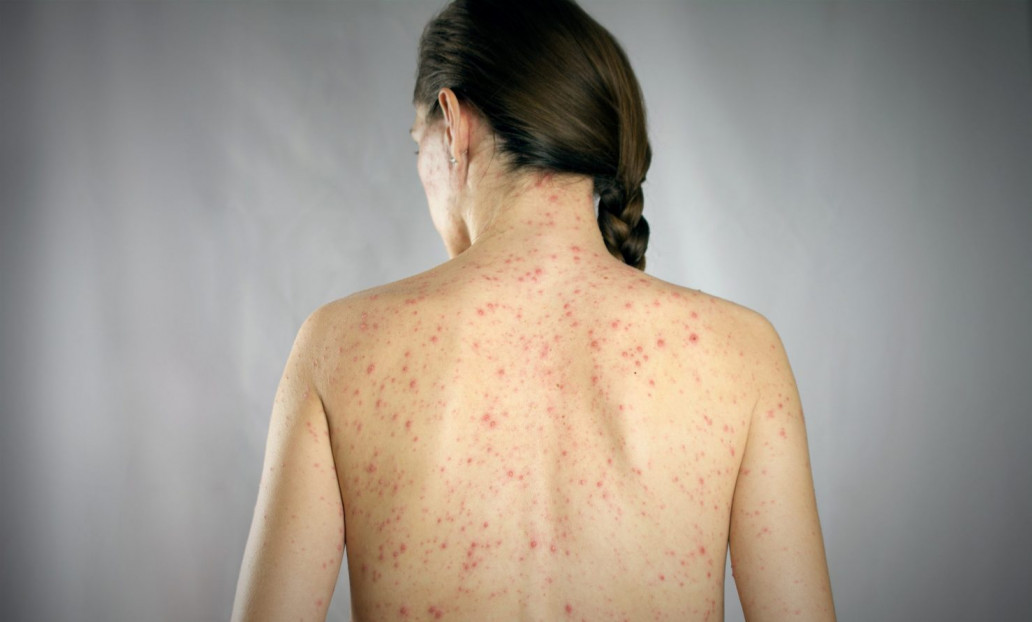 Sarampion en México