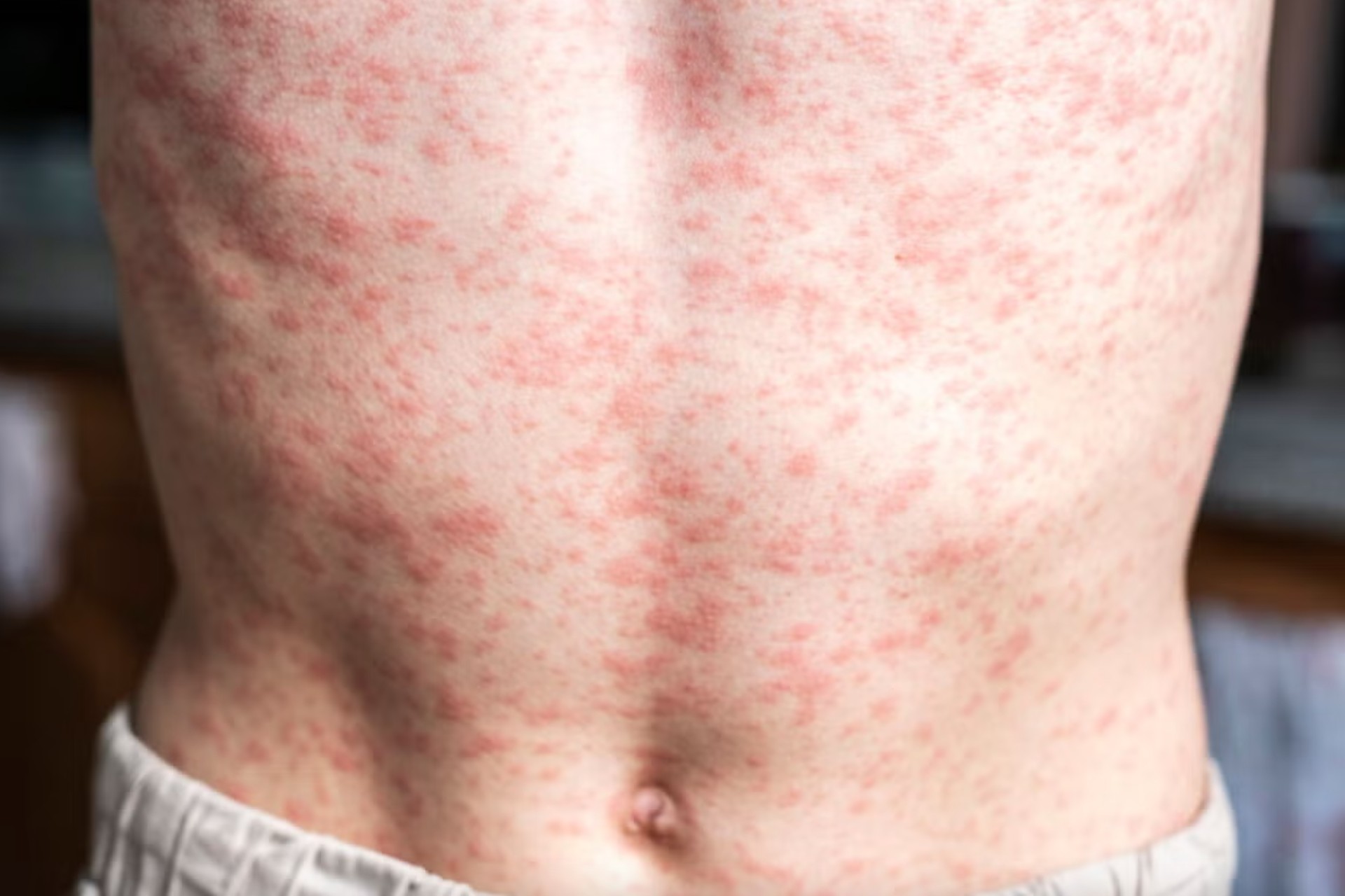 Casos de sarampion en Mexico