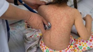 Reducen contagios de sarampión tras aplicar más de 17 millones de vacunas en México