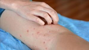 Sarampión en Yucatán registra aumento de contagios con ocho casos nuevos en una semana