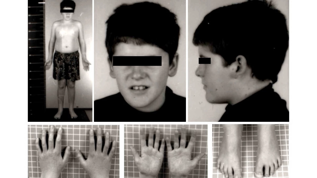El síndrome de Prader Willi altera el hipotálamo y provoca obesidad, retraso intelectual y conductas compulsivas desde el nacimiento.