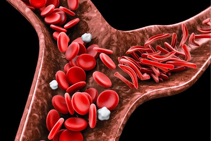 Terapias genéticas logran curar la anemia falciforme, pero cuestan millones de dólares
